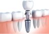 Tooth Extractions and Preservation: Ensuring Optimal Oral Health and Function