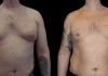 Understanding Male Breast Reduction Surgery: Causes and Treatments